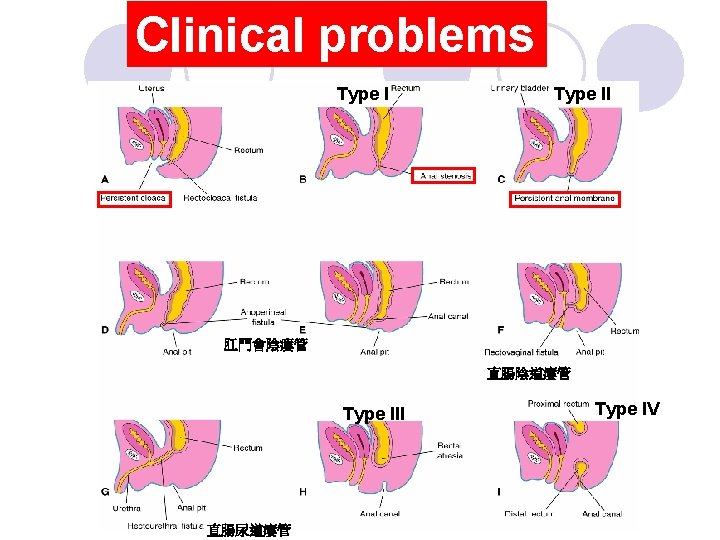 Clinical problems Type II 肛門會陰瘻管 直腸陰道瘻管 Type III 直腸尿道瘻管 Type IV 
