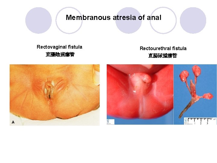 Membranous atresia of anal Rectovaginal fistula 直腸陰道瘻管 Rectourethral fistula 直腸尿道瘻管 