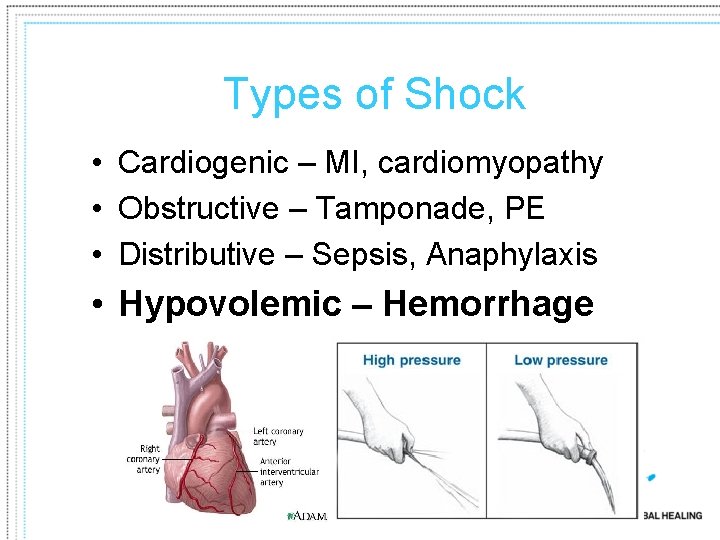 Types of Shock • Cardiogenic – MI, cardiomyopathy • Obstructive – Tamponade, PE •
