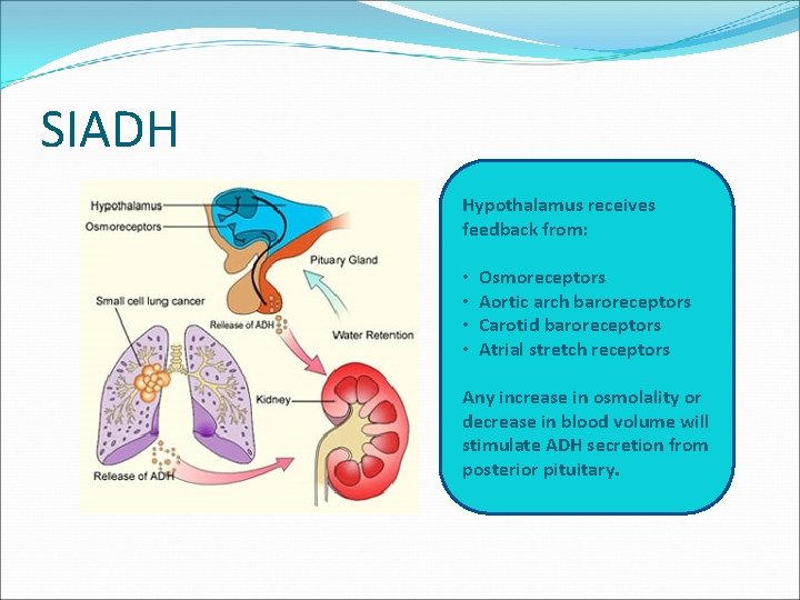 SIADH Hypothalamus receives feedback from: • • Osmoreceptors Aortic arch baroreceptors Carotid baroreceptors Atrial