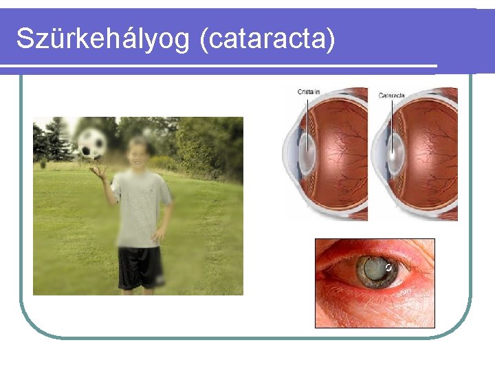 Szürkehályog (cataracta) 