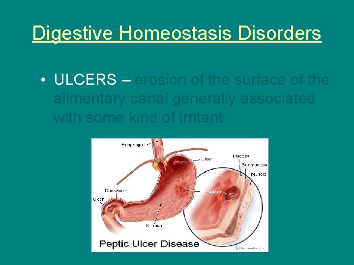 Digestive Homeostasis Disorders • ULCERS – erosion of the surface of the alimentary canal