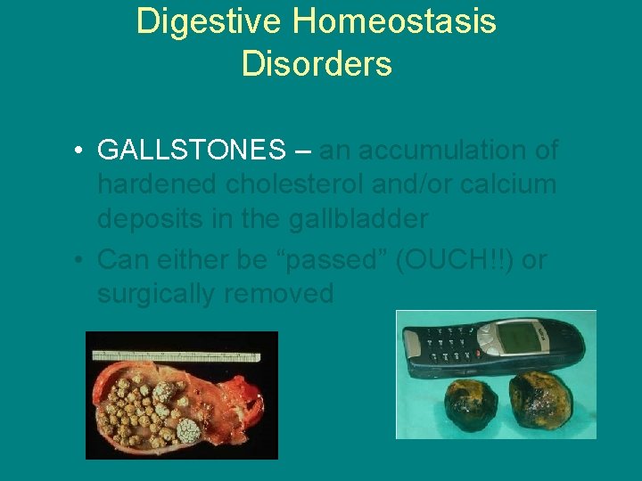 Digestive Homeostasis Disorders • GALLSTONES – an accumulation of hardened cholesterol and/or calcium deposits