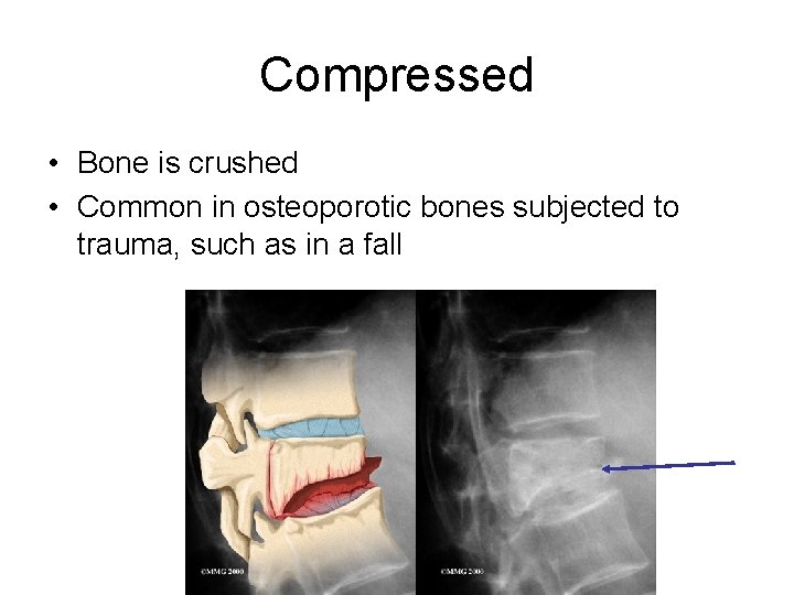 Compressed • Bone is crushed • Common in osteoporotic bones subjected to trauma, such