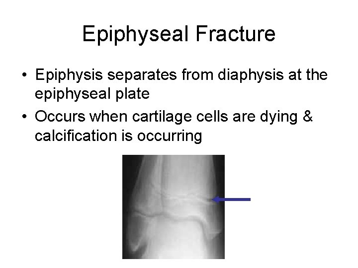 Epiphyseal Fracture • Epiphysis separates from diaphysis at the epiphyseal plate • Occurs when