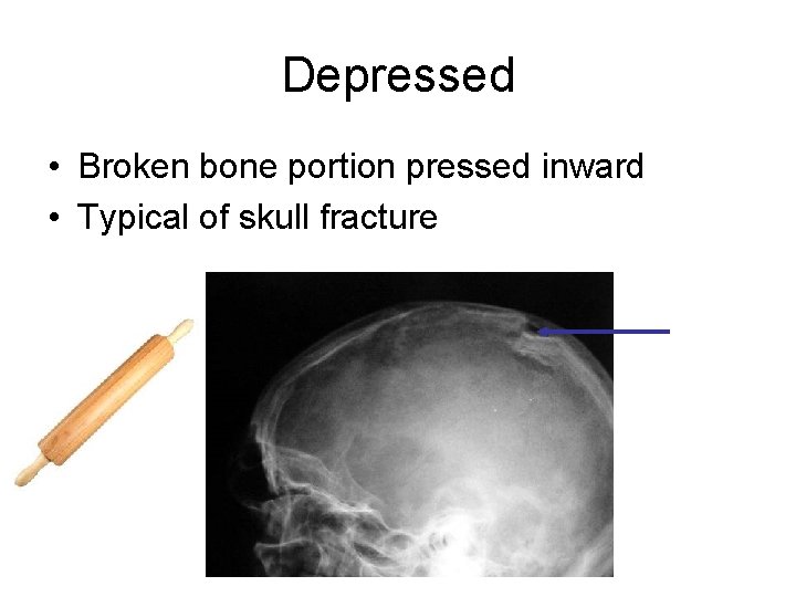 Depressed • Broken bone portion pressed inward • Typical of skull fracture 