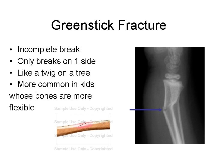 Greenstick Fracture • Incomplete break • Only breaks on 1 side • Like a