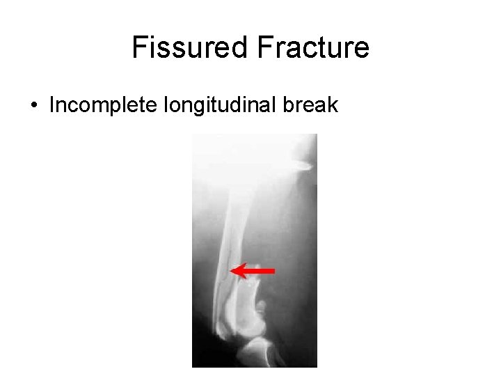 Fissured Fracture • Incomplete longitudinal break 