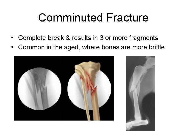 Comminuted Fracture • Complete break & results in 3 or more fragments • Common