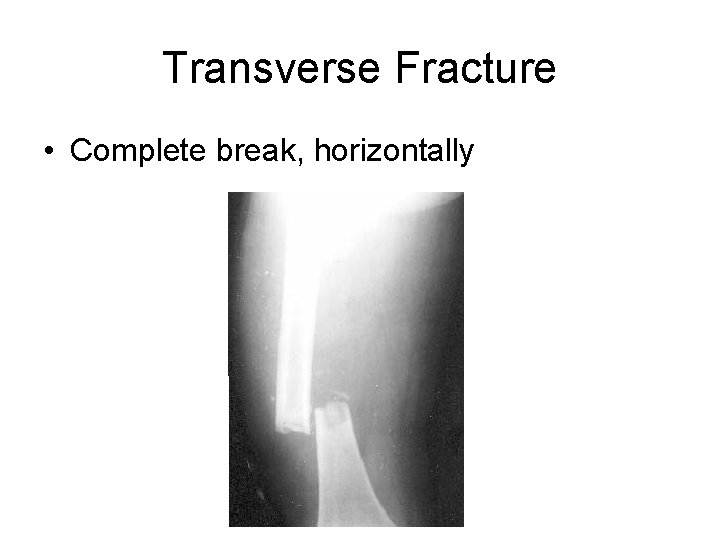 Transverse Fracture • Complete break, horizontally 