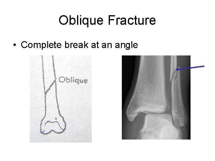 Oblique Fracture • Complete break at an angle 