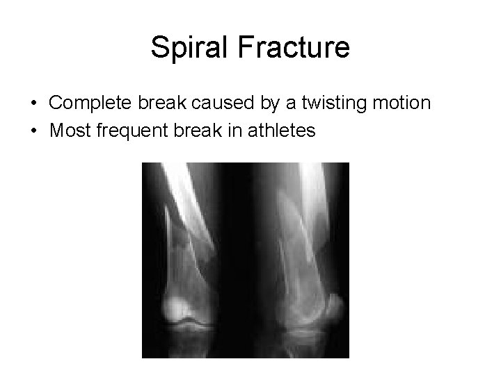 Spiral Fracture • Complete break caused by a twisting motion • Most frequent break