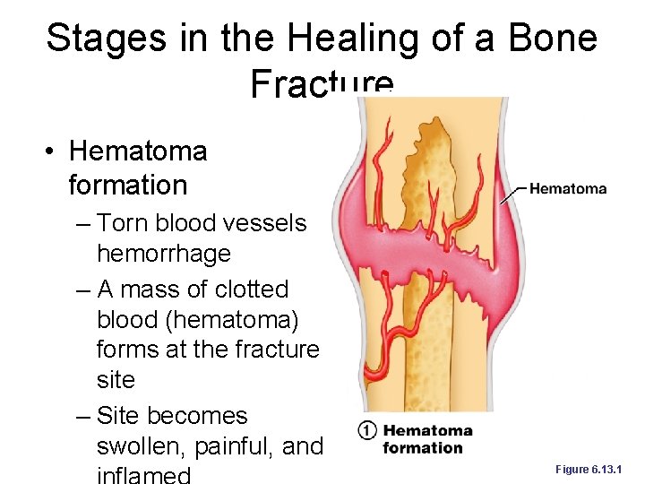 Stages in the Healing of a Bone Fracture • Hematoma formation – Torn blood