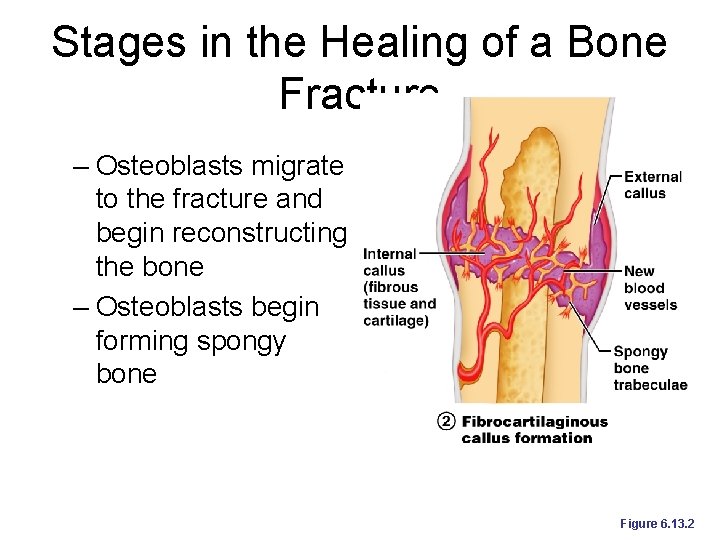 Stages in the Healing of a Bone Fracture – Osteoblasts migrate to the fracture