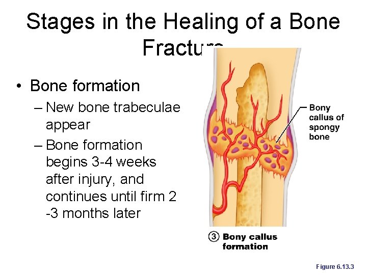 Stages in the Healing of a Bone Fracture • Bone formation – New bone