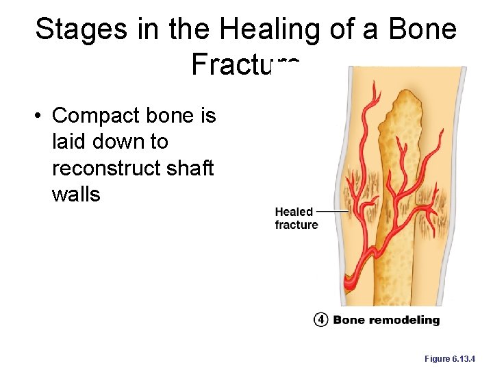 Stages in the Healing of a Bone Fracture • Compact bone is laid down