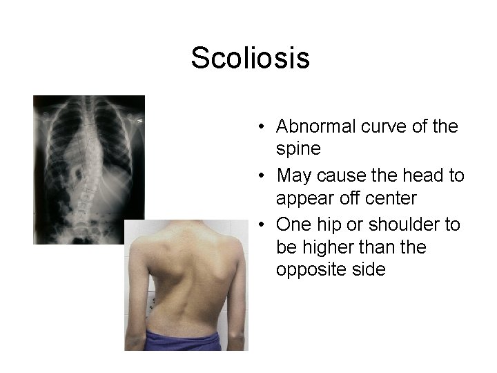 Scoliosis • Abnormal curve of the spine • May cause the head to appear