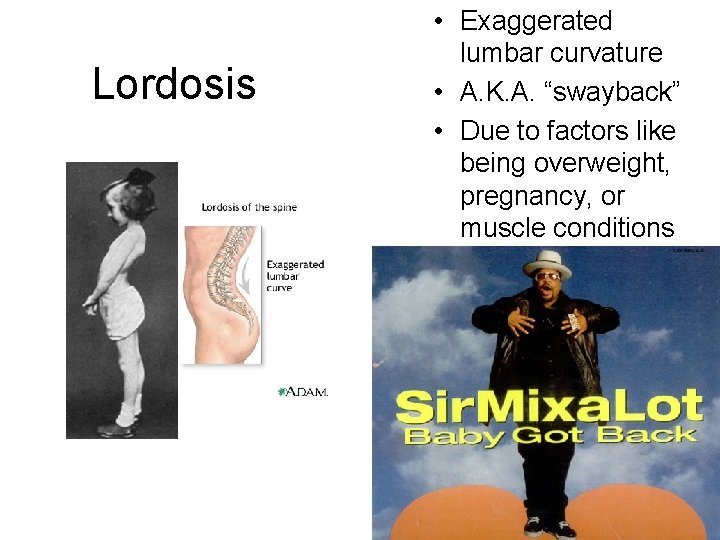 Lordosis • Exaggerated lumbar curvature • A. K. A. “swayback” • Due to factors