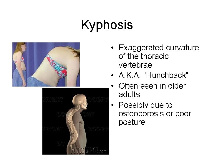 Kyphosis • Exaggerated curvature of the thoracic vertebrae • A. K. A. “Hunchback” •