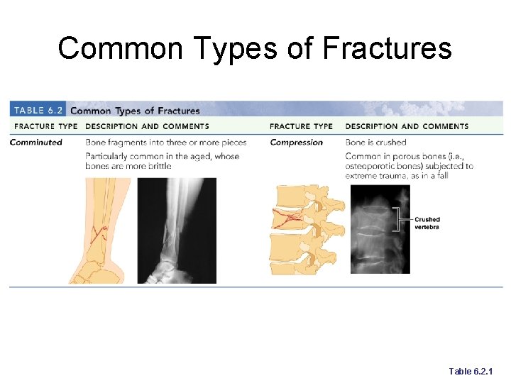 Common Types of Fractures Table 6. 2. 1 