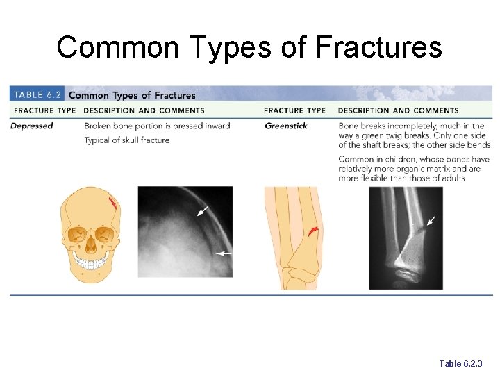 Common Types of Fractures Table 6. 2. 3 