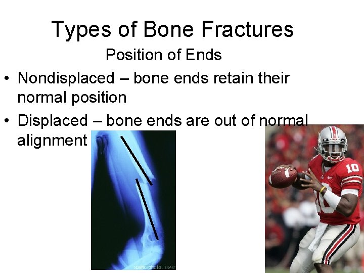 Types of Bone Fractures Position of Ends • Nondisplaced – bone ends retain their