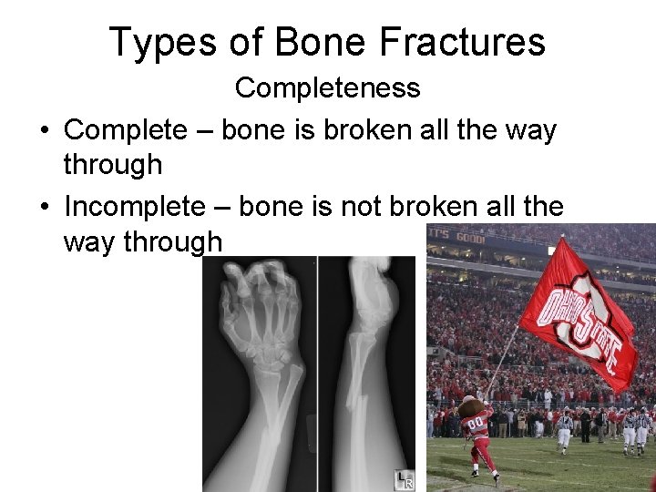 Types of Bone Fractures Completeness • Complete – bone is broken all the way