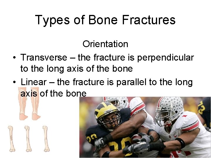 Types of Bone Fractures Orientation • Transverse – the fracture is perpendicular to the