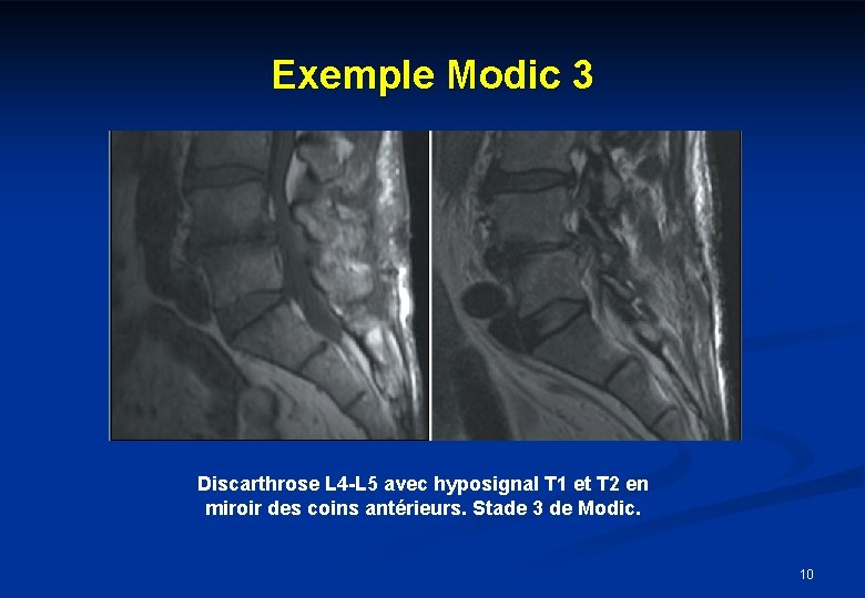 Exemple Modic 3 Discarthrose L 4 -L 5 avec hyposignal T 1 et T