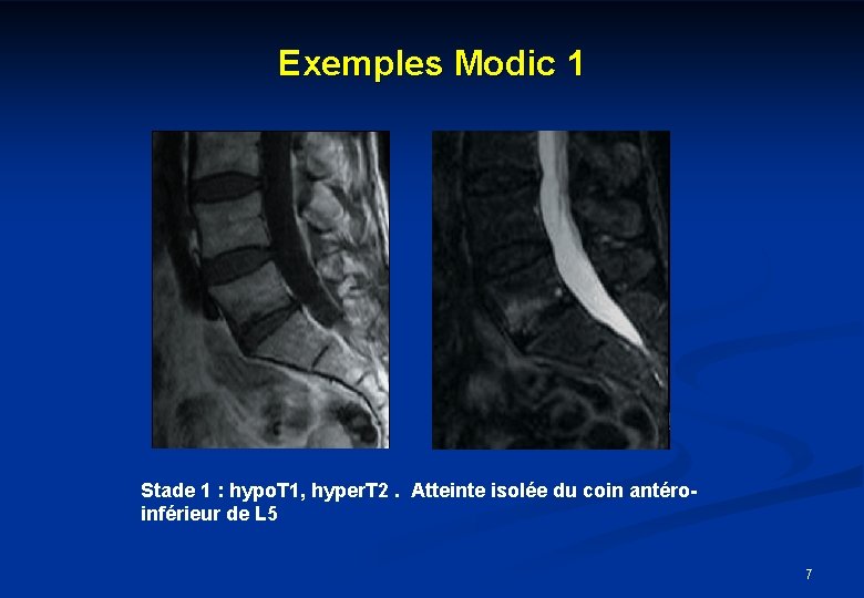 Exemples Modic 1 Stade 1 : hypo. T 1, hyper. T 2. Atteinte isolée