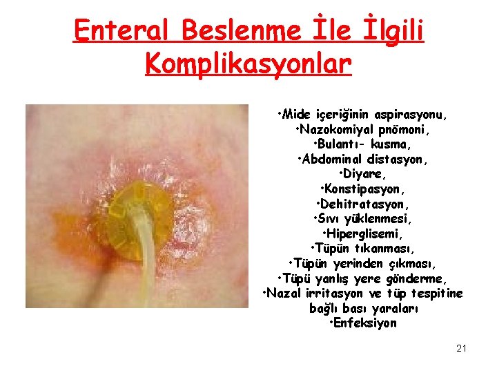 Enteral Beslenme İlgili Komplikasyonlar • Mide içeriğinin aspirasyonu, • Nazokomiyal pnömoni, • Bulantı- kusma,