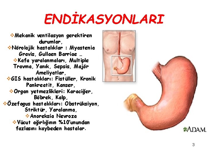 ENDİKASYONLARI v. Mekanik ventilasyon gerektiren durumlar, v. Nörolojik hastalıklar : Myastenia Gravis, Gullaen Barriae