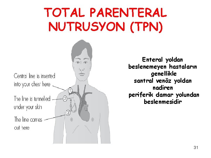 TOTAL PARENTERAL NUTRUSYON (TPN) Enteral yoldan beslenemeyen hastaların genellikle santral venöz yoldan nadiren periferik