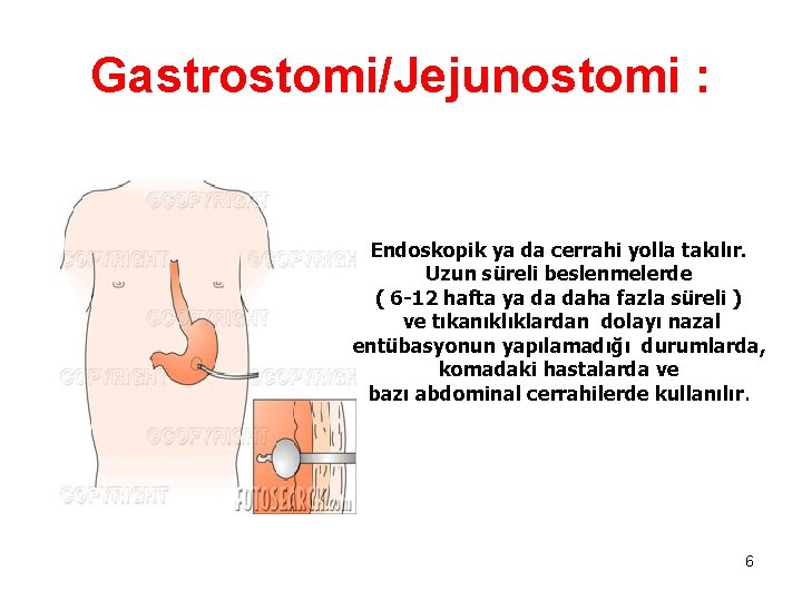 Gastrostomi/Jejunostomi : Endoskopik ya da cerrahi yolla takılır. Uzun süreli beslenmelerde ( 6 -12