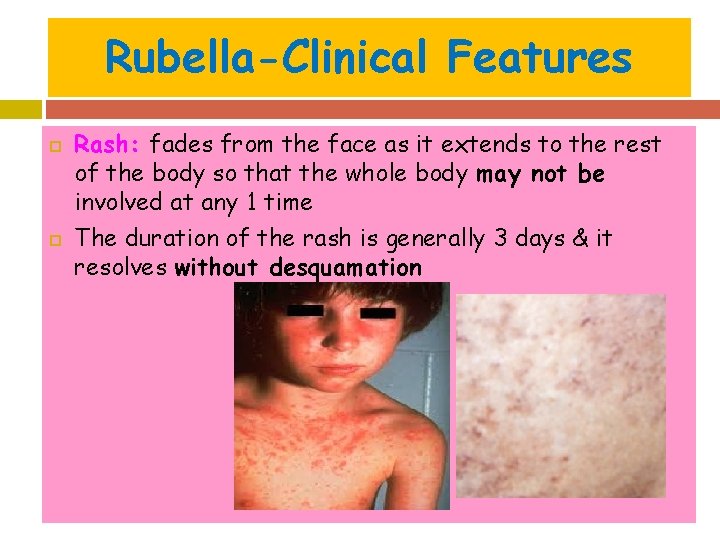 Rubella-Clinical Features Rash: fades from the face as it extends to the rest of