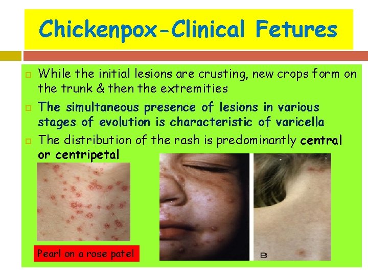 Chickenpox-Clinical Fetures While the initial lesions are crusting, new crops form on the trunk