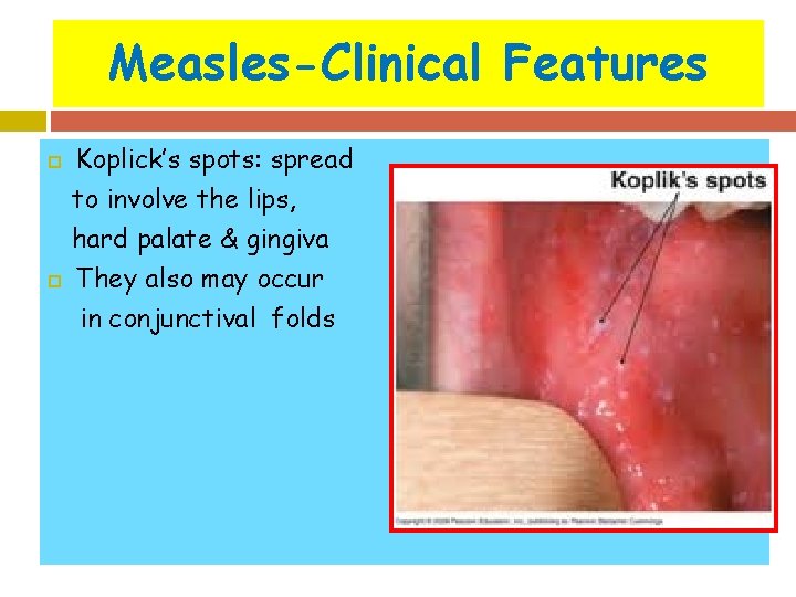 Measles-Clinical Features Koplick’s spots: spread to involve the lips, hard palate & gingiva They
