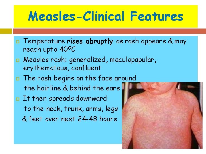 Measles-Clinical Features Temperature rises abruptly as rash appears & may reach upto 40 OC