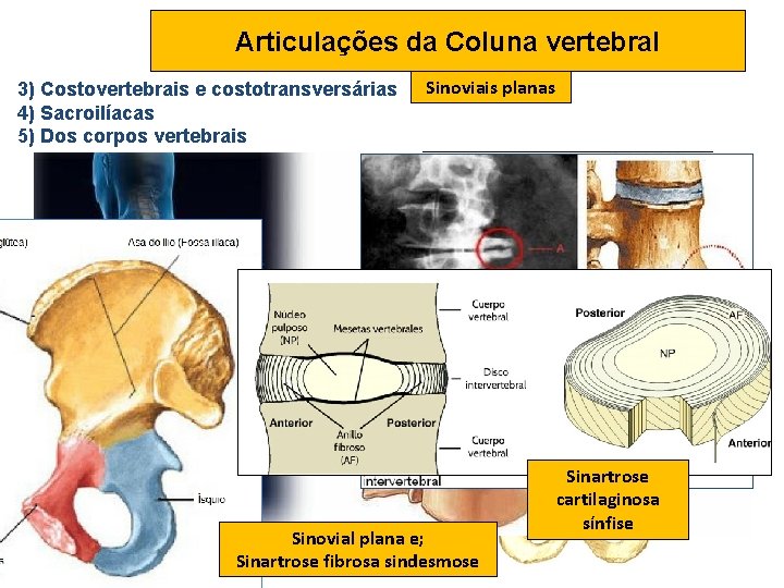 Articulações da Coluna vertebral 3) Costovertebrais e costotransversárias 4) Sacroilíacas 5) Dos corpos vertebrais