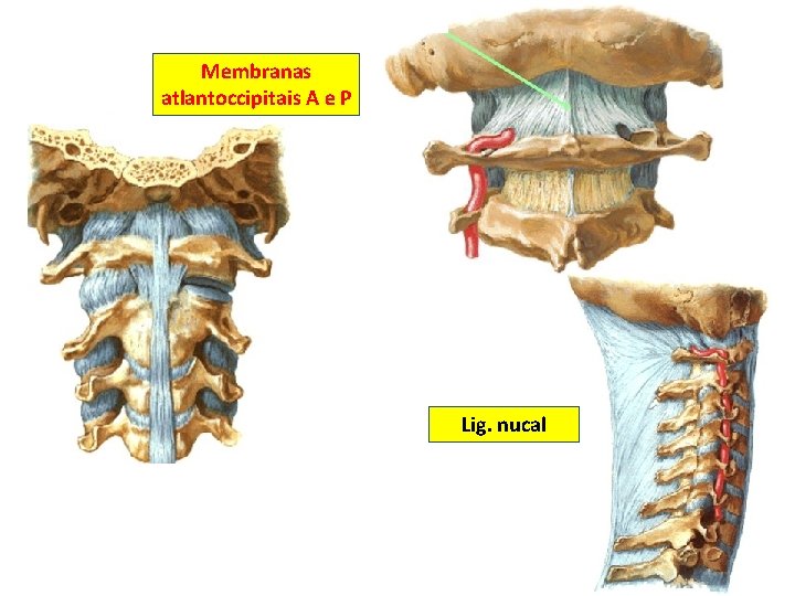 Membranas atlantoccipitais A e P Lig. nucal 