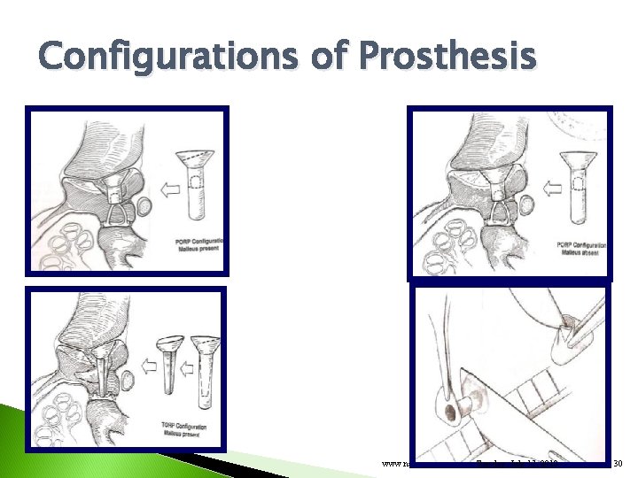 Configurations of Prosthesis www. nayyar. ENT. com Tuesday, July 17, 2012 30 