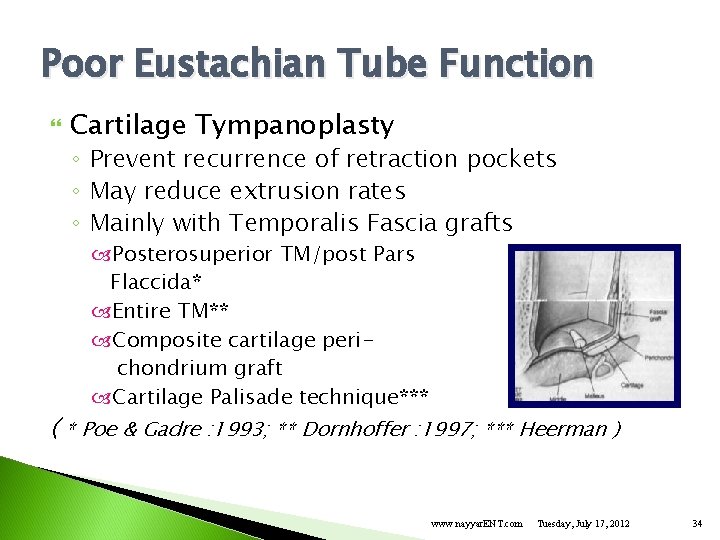 Poor Eustachian Tube Function Cartilage Tympanoplasty ◦ Prevent recurrence of retraction pockets ◦ May