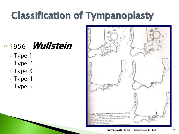 Classification of Tympanoplasty 1956◦ ◦ ◦ Type Type Wullstein 1 2 3 4 5