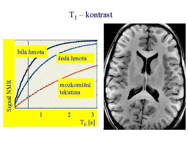 T 1 – kontrast Signál NMR bílá hmota šedá hmota mozkomíšní tekutina 1 2