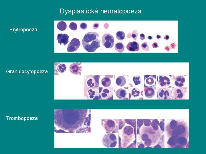 Dysplastická hematopoeza Erytropoeza Granulocytopoeza Trombopoeza 