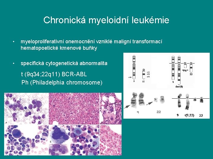 Chronická myeloidní leukémie • myeloproliferativní onemocnění vzniklé maligní transformací hematopoetické kmenové buňky • specifická