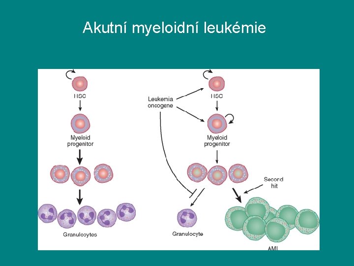 Akutní myeloidní leukémie 