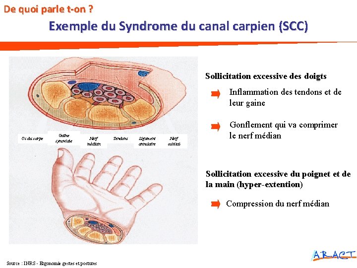 De quoi parle t-on ? Exemple du Syndrome du canal carpien (SCC) Sollicitation excessive