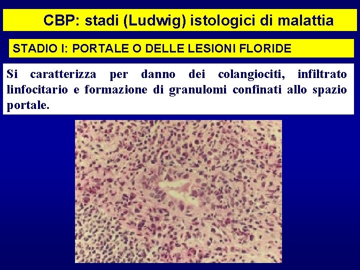 CBP: stadi (Ludwig) istologici di malattia STADIO I: PORTALE O DELLE LESIONI FLORIDE Si