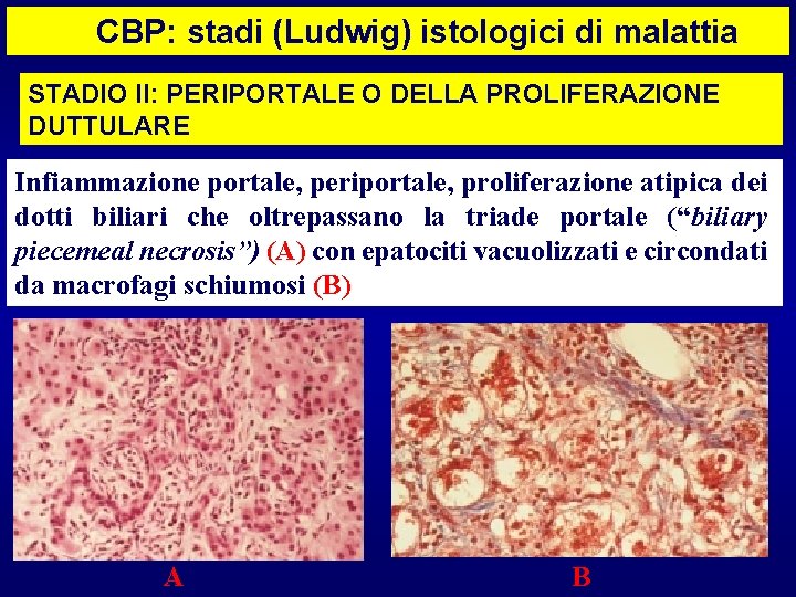 CBP: stadi (Ludwig) istologici di malattia STADIO II: PERIPORTALE O DELLA PROLIFERAZIONE DUTTULARE Infiammazione